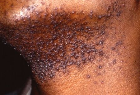 Pseudofolliculitis barbae (PFB), eliminates razor bumps